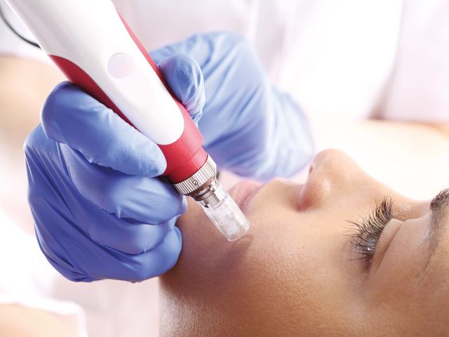 Professionelle Microneedling-Behandlung bei Skin Art Cosmetics
